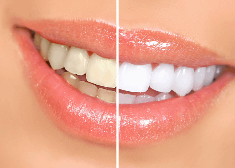 Zahnbleaching Zahnbleaching Vorher-Nachher: ein Strahlen, das sich sehen lässt!